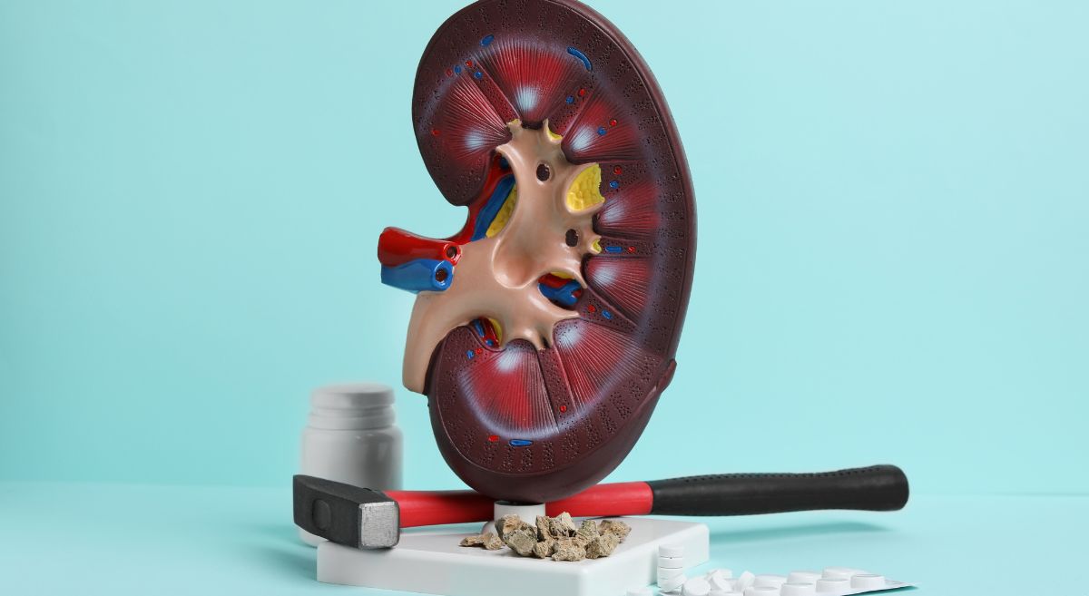 What Are Kidney Stones?