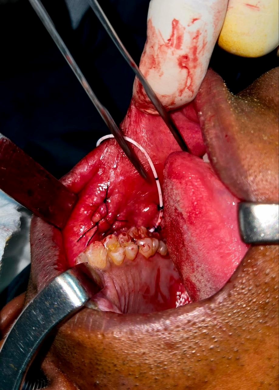 Fig. 5: Circumferential dissection around encapsulated adenoma.