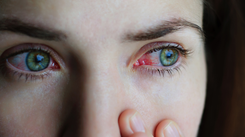 Red eyes