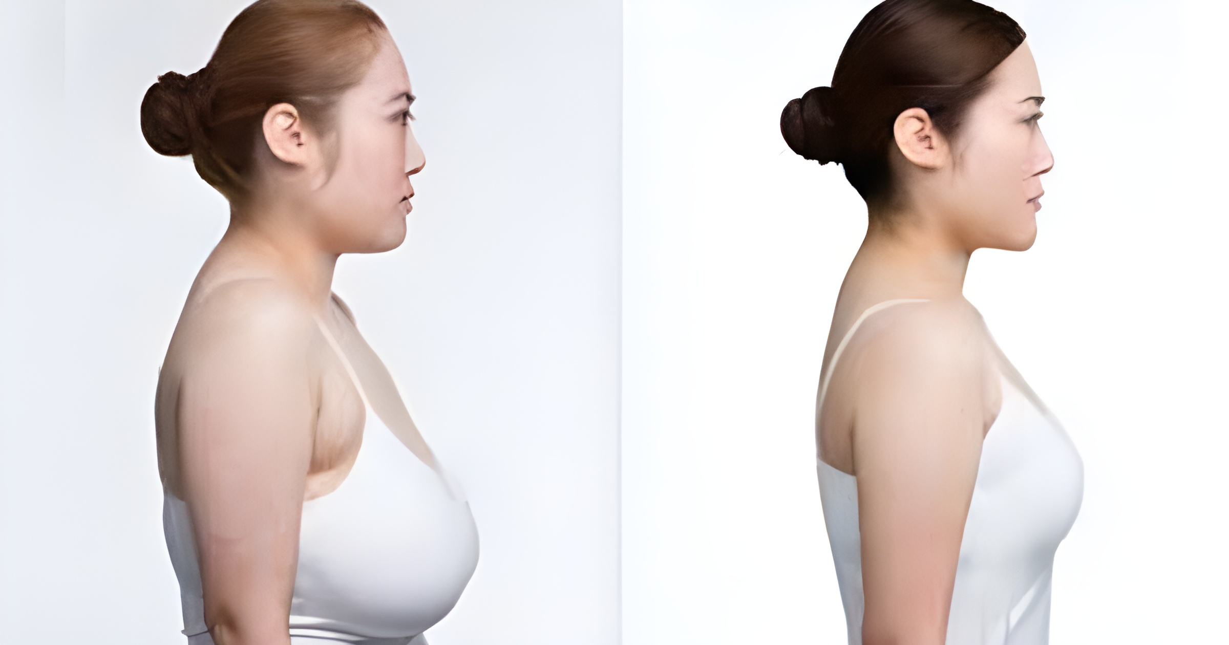 Breast reducton 