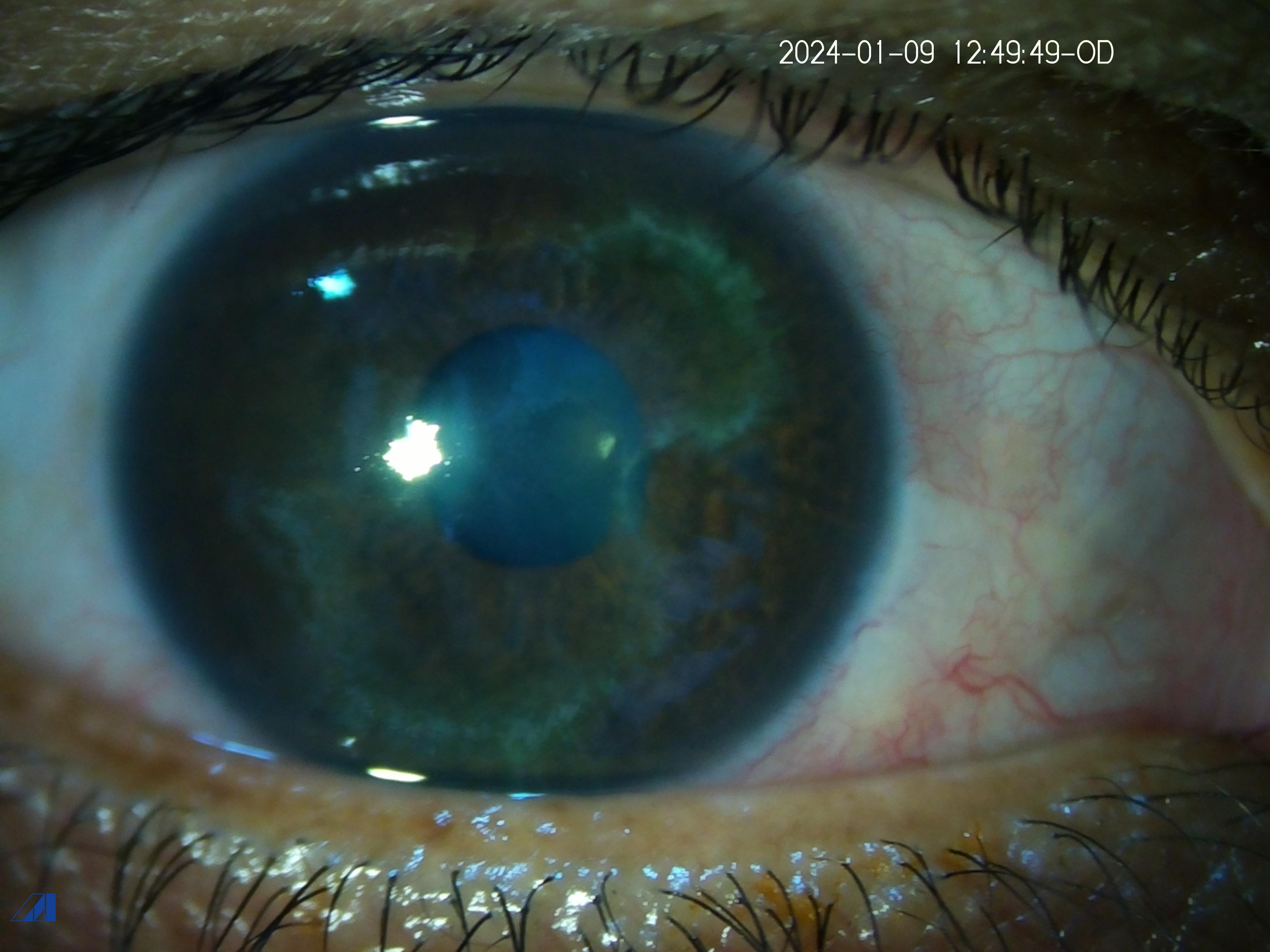 Migratory Corneal 1  st presentation