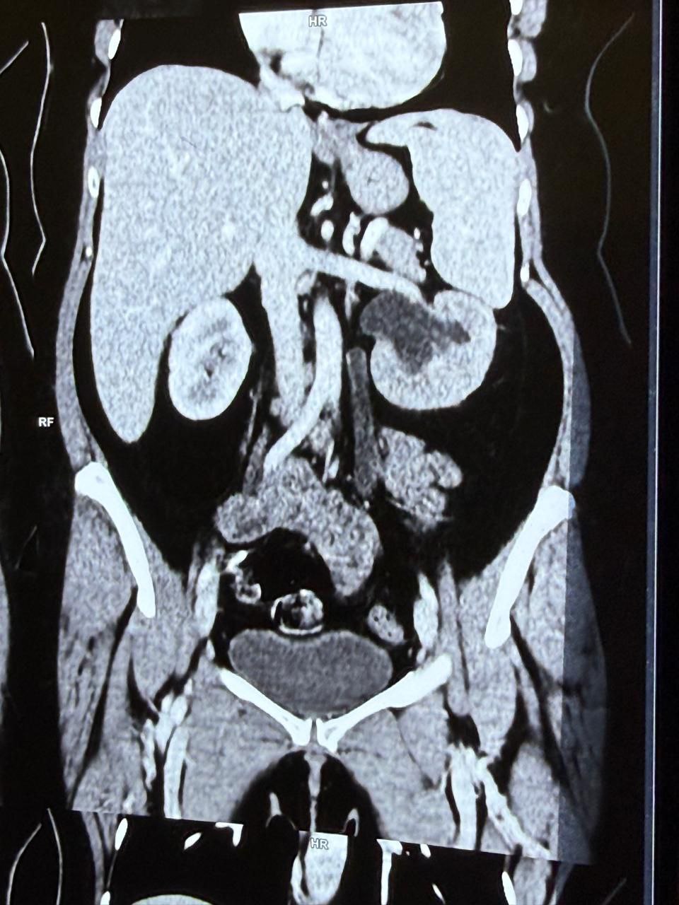 Uretero-Vaginal Fistula 