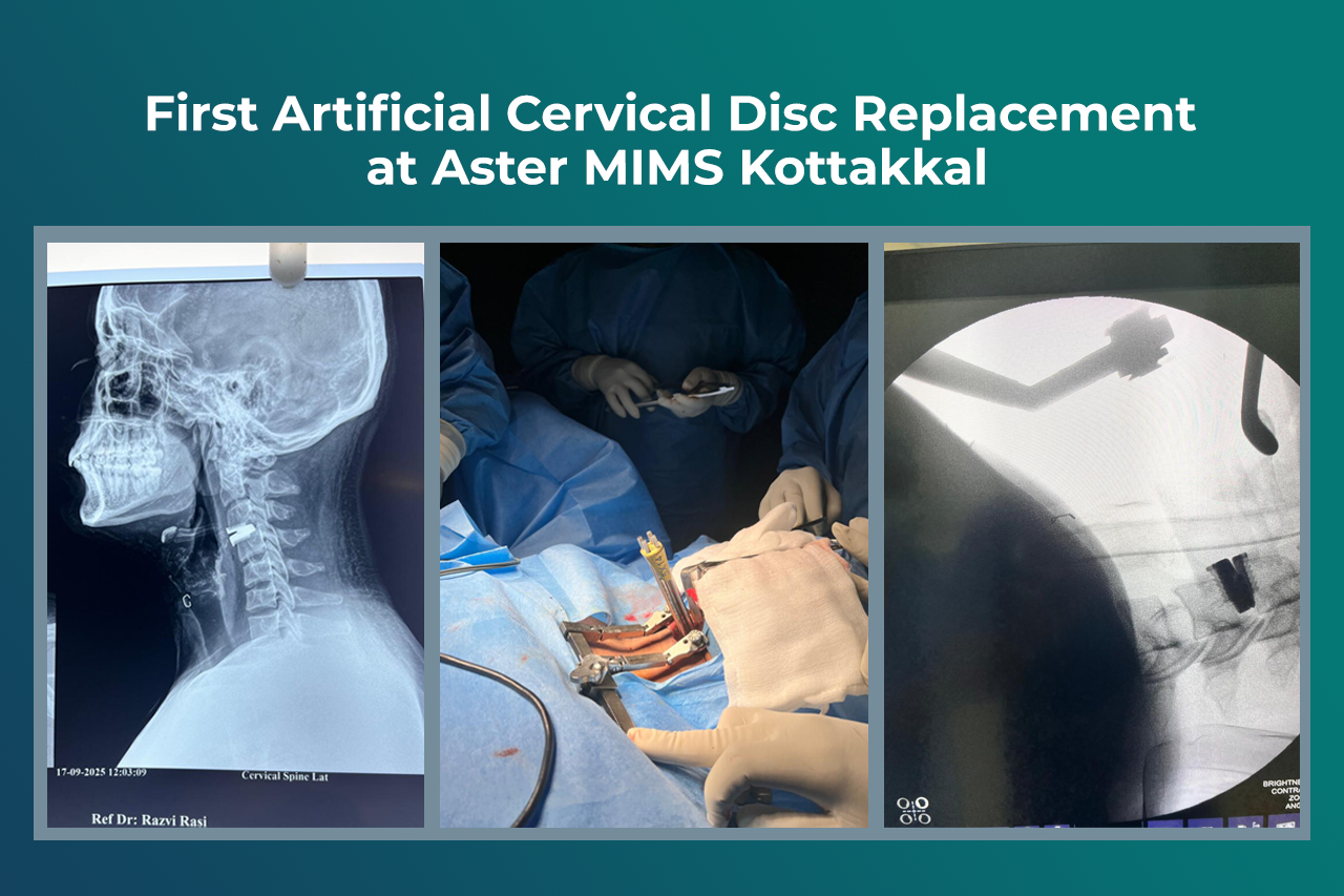  Patient Success Story | Advanced Spine Care Aster MIMS Hospital, Kottakkal, continues to advance in delivering cutting-edge spine care with the successful completion of its first artificial cervical disc replacement surgery.  Patient Overview A 23-year-old IT professional, Mr. Akshay Sagar, presented with:  Persistent neck pain Pain radiating to the right upper limb Difficulty in daily activities affecting work performance Following clinical evaluation and imaging, he was diagnosed with C3–C4 Intervertebra