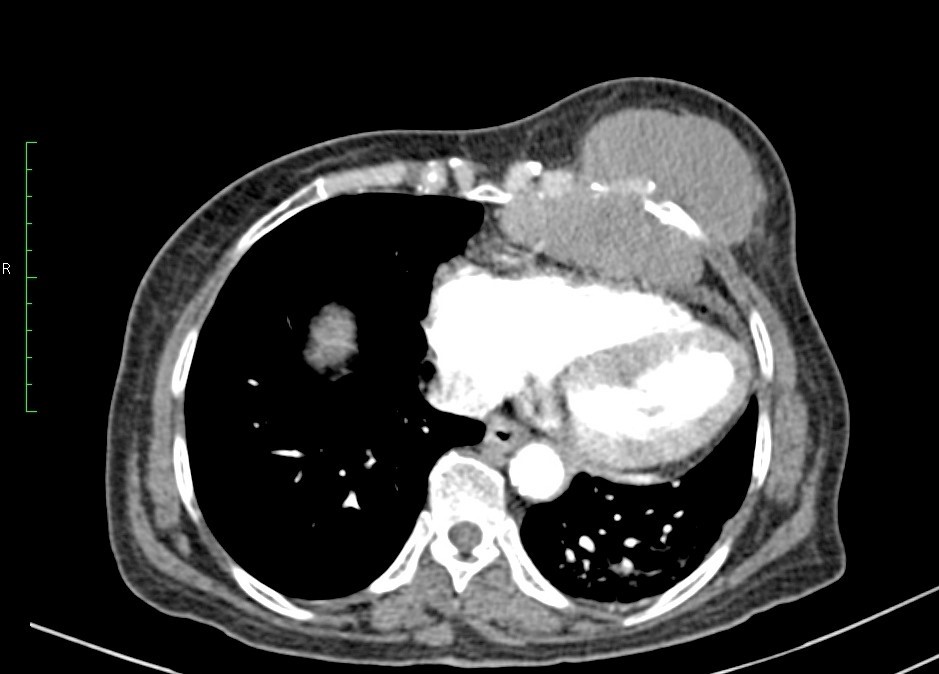 Chest wall 1