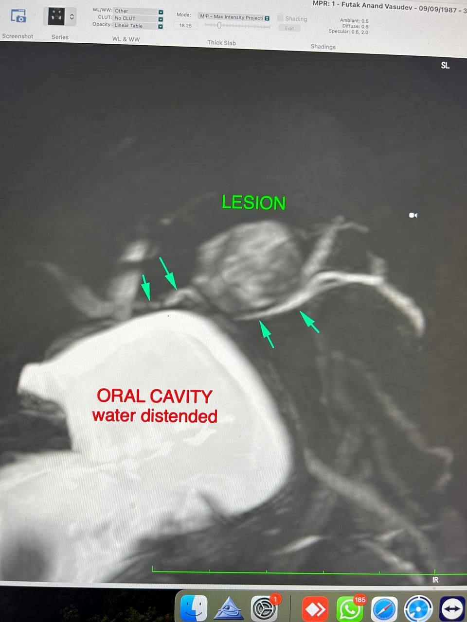 Parotid 1