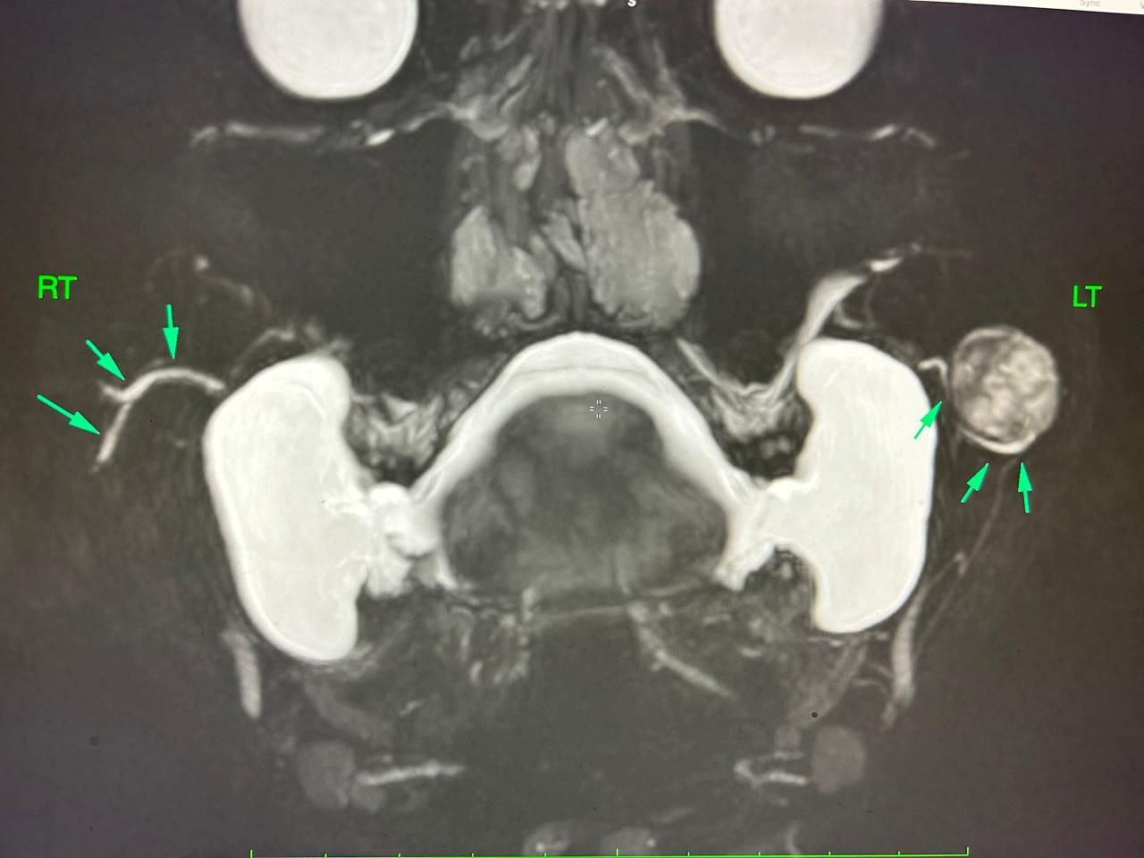 parotid 2