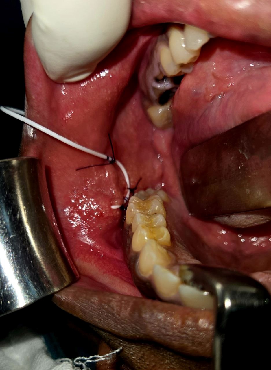Parotid 5