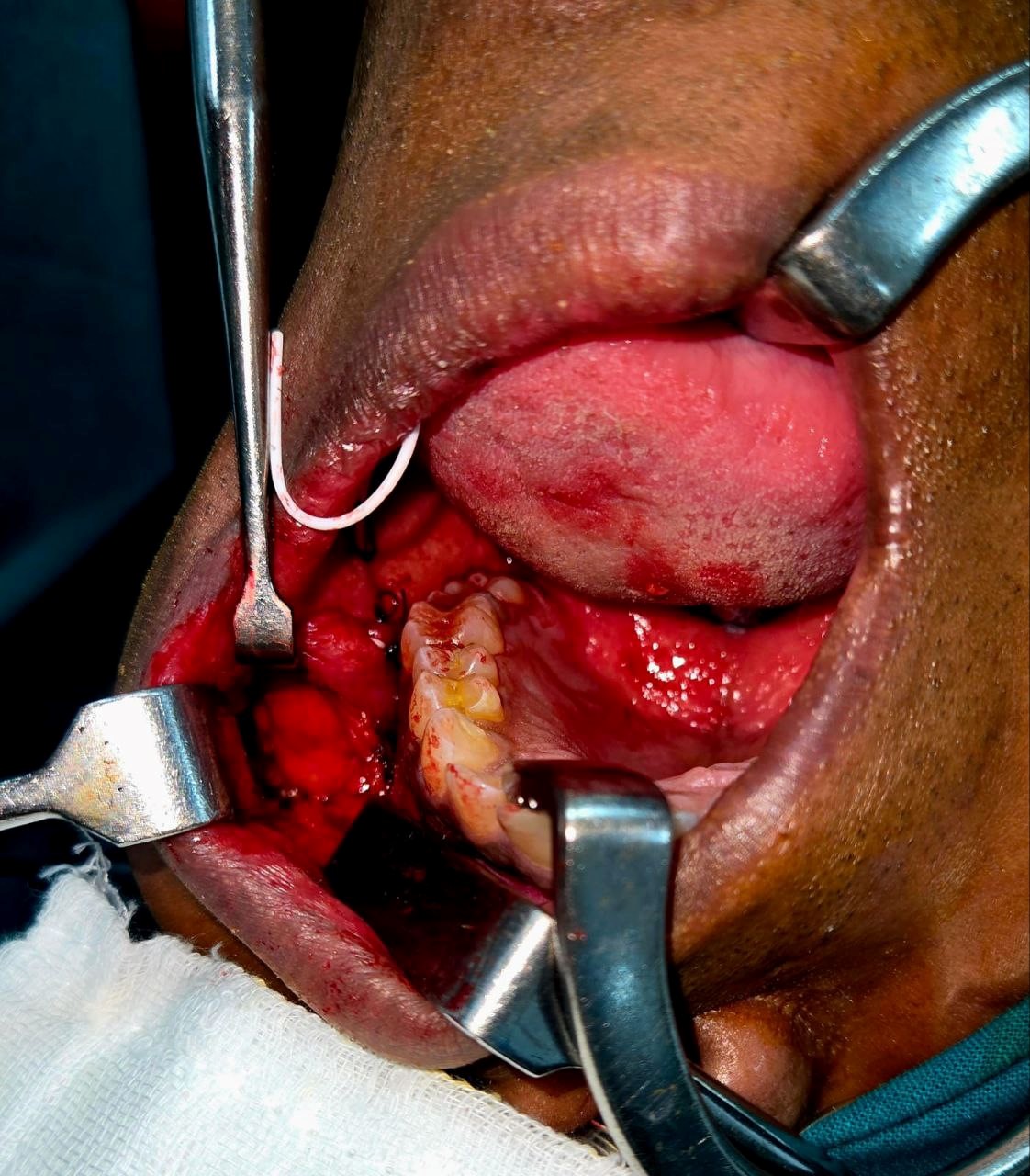 Parotid 7