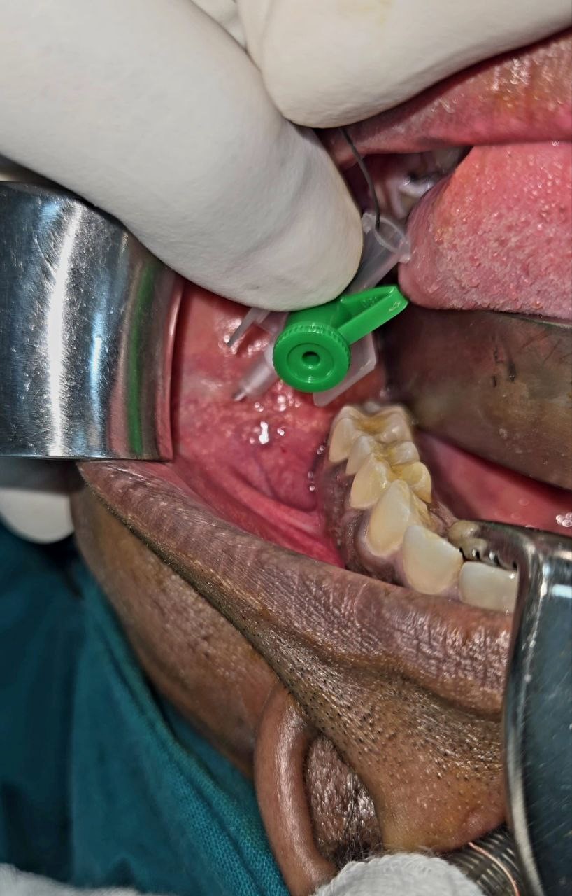 Parotid 3