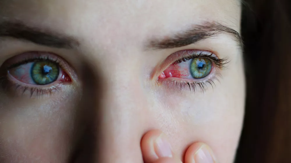 Red eyes