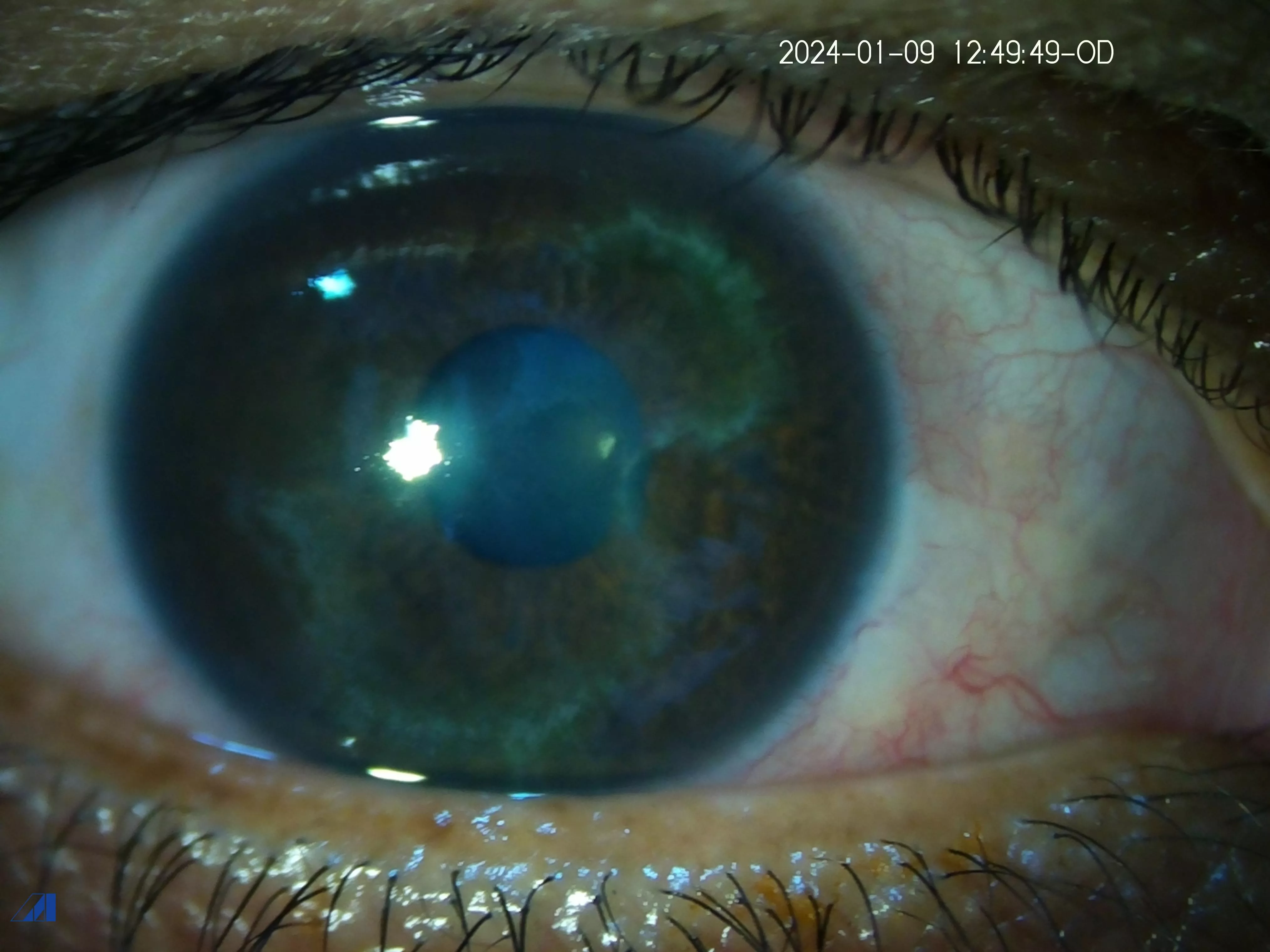 Migratory Corneal 1  st presentation