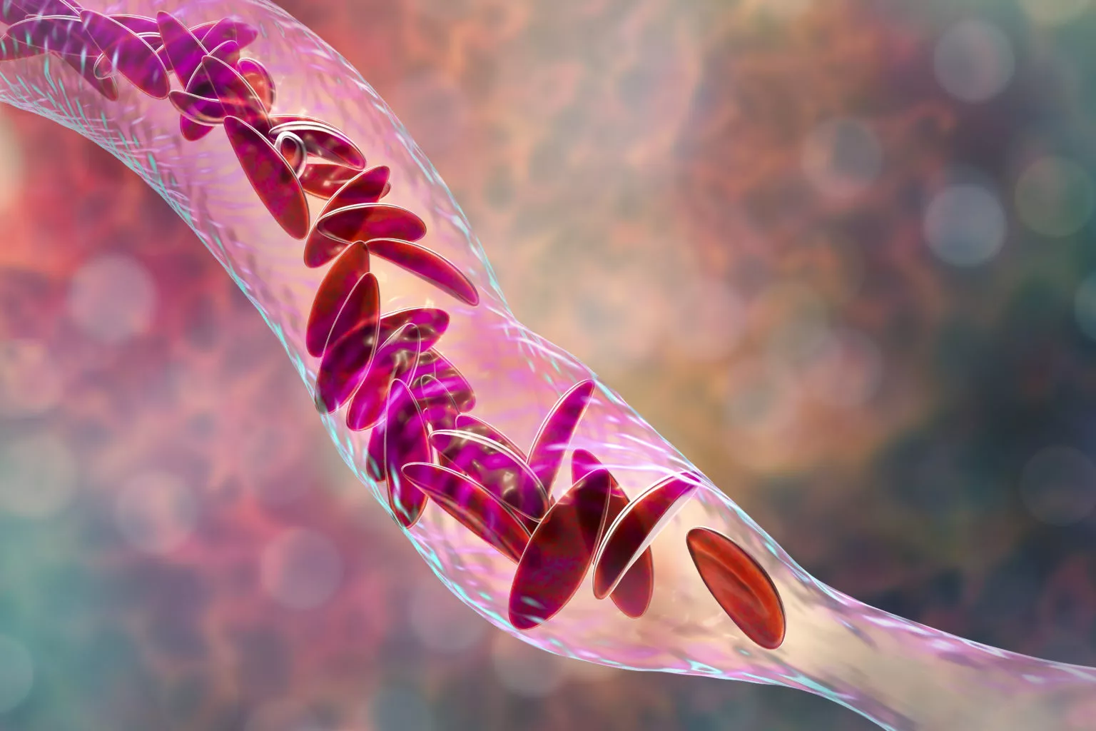 Sickle Cell