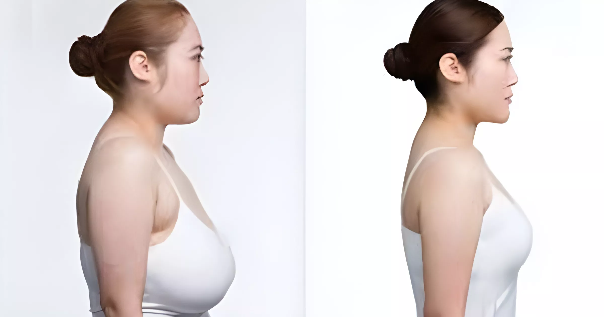 Breast reducton 